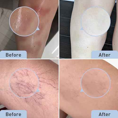 Procure Bruise Remedy