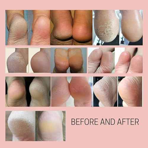 Callus Remover - Three Minutes Quick Fix- Foot File Rasp - Instant Foot Exfoliating Softener Peel Spray, Heels Callus Scrubber File - Home Spa Pedicure Treatment. Wonder Pedi