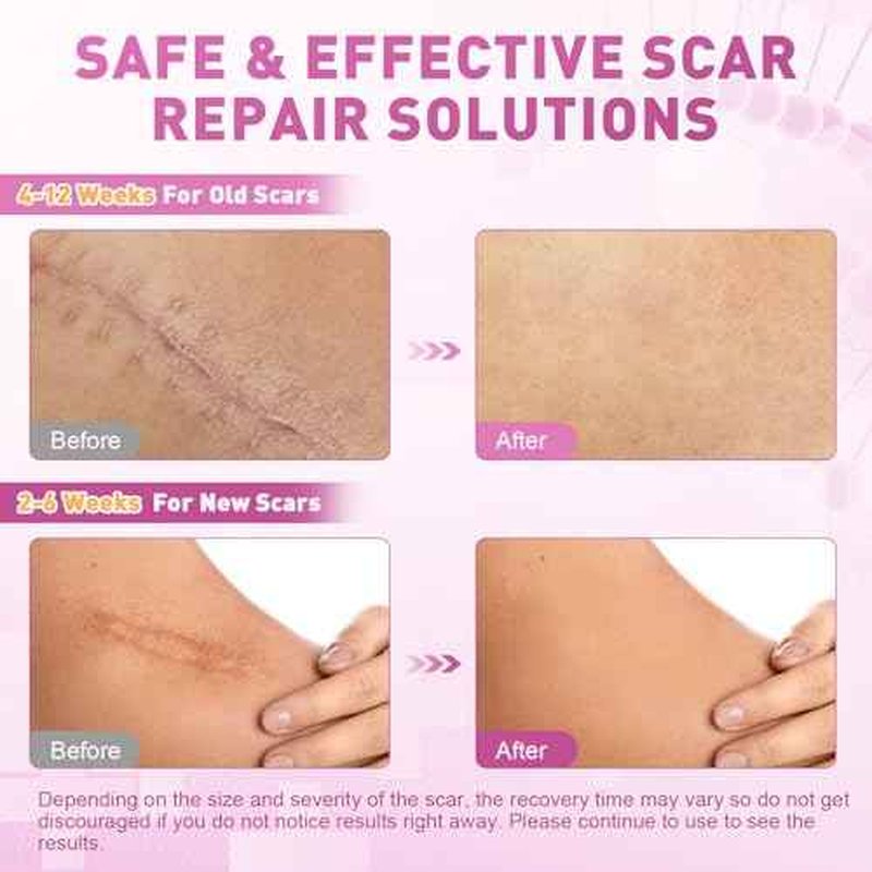 Silicone Scar Sheets & Tape (1.6" x 120"-3M) - Reusable Soft Medical Grade Silicone Strips Patches for Surgical, Keloid, Acne, Burn, C - Section, Facial & Face Skin Scars