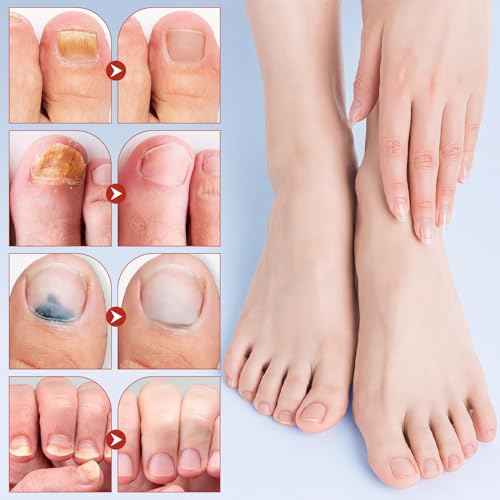 Toenail Repair Extra Strength,Nail Patches 21 PCS, Overnight Nail Fast Acting Repair Effortless Hydrogel Nail Care for Men and Women