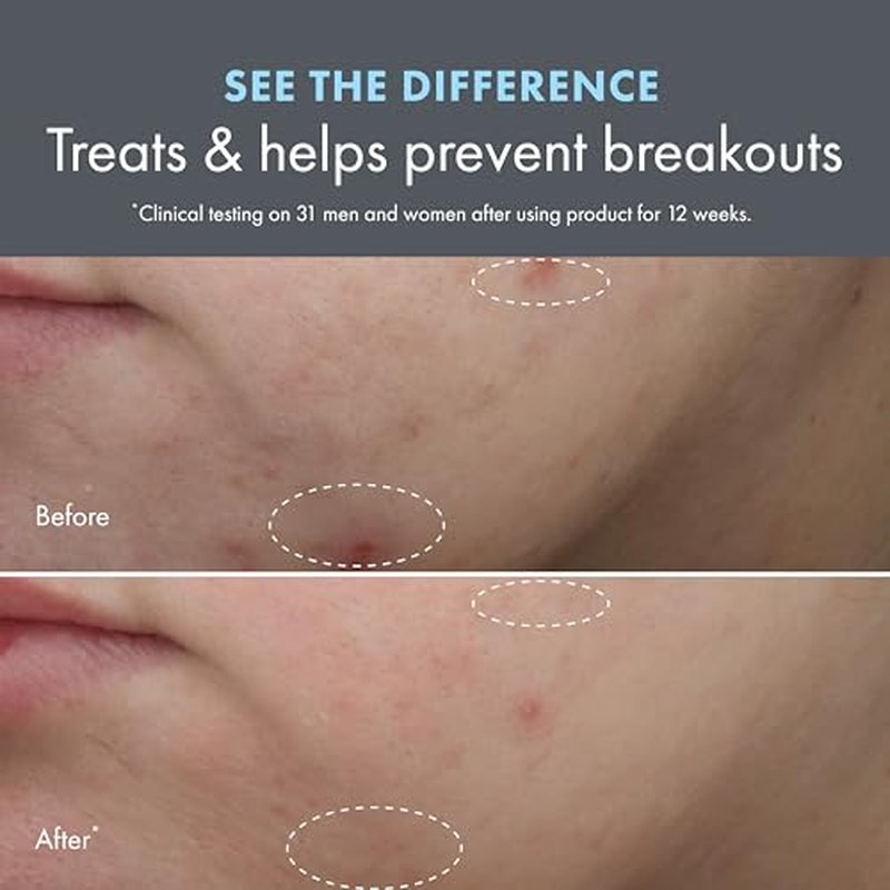 Origins Clear Improvement Acne Moisturizer | To Clear & Prevent Acne Breakouts & Pimples | With Salicylic Acid & Hyaluronic Acid, 1.7 Fl Oz