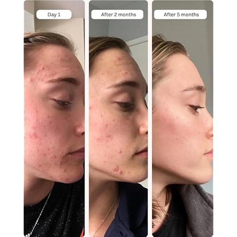 Averr Aglow Clear Skin Elixir, Face Mask Prevent Breakouts, Clear Acne & Oily Skin, Fade Scars Marks, Natural Skincare Solution, Reducer & Pores Cleanser Treatment, Natural Younger Looking Skin