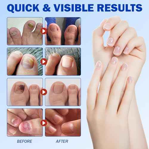 Fungal Nail Patches, Nail patches for toenails, Overnight Toe Nails Treatments for Damaged Foot Nails Repair and Care, Safe for Sensitive Skin, Easy to Apply (2)