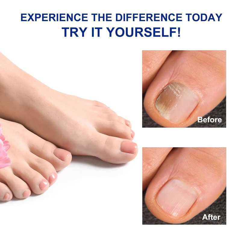 Extra Strength Toenail Treatment | 8-Hour Overnight Repair for Ingrown Nails, Strengthens Brittle Nails, Hypoallergenic (64 Patches)