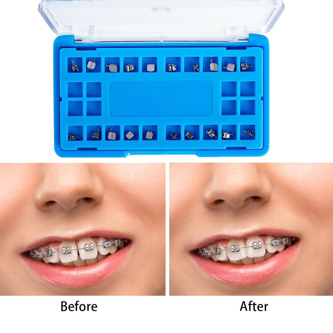 EASYTODENTA Dental Orthodontic Self-Ligating Metal Bracket Passive Dental Metal Braces with Open Tools Slot (ROTH 022 345 with HOOKS)