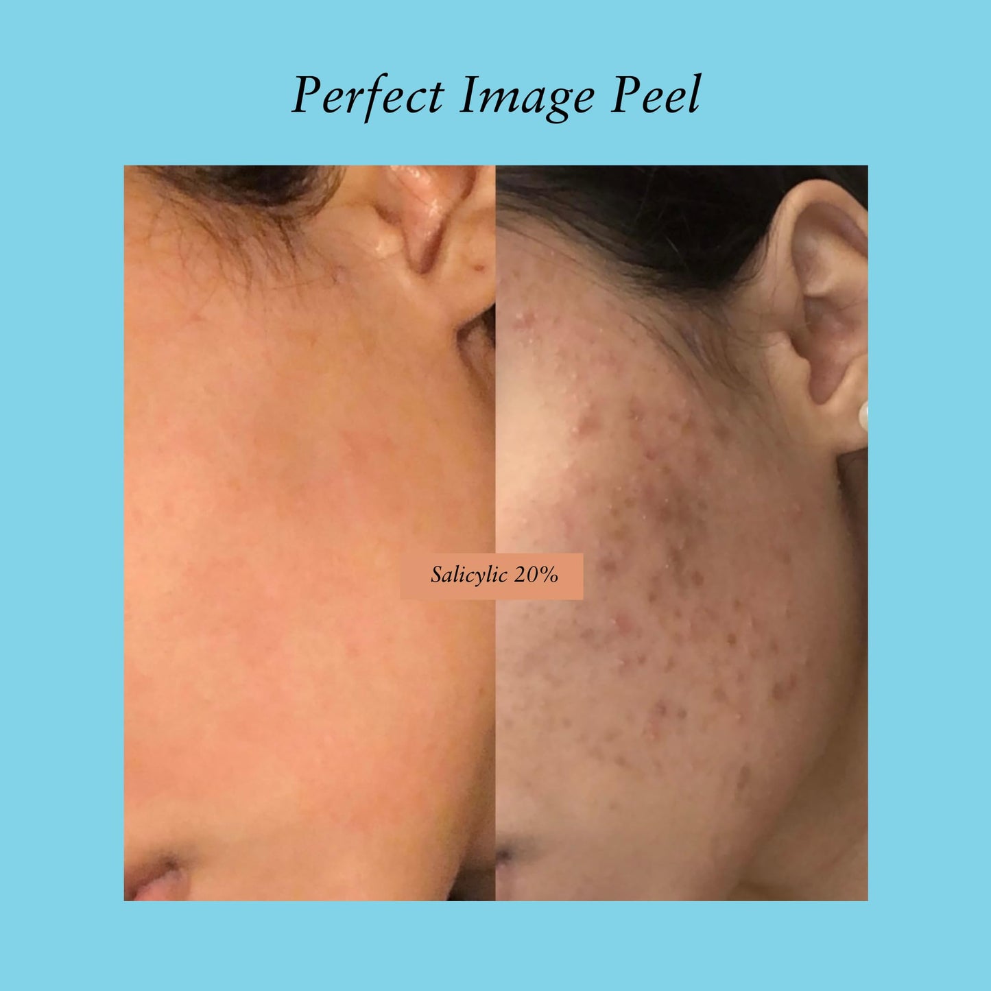 Salicylic Gel Chemical Peel - Enhanced with Green Tea Extract and Tea Tree Oil