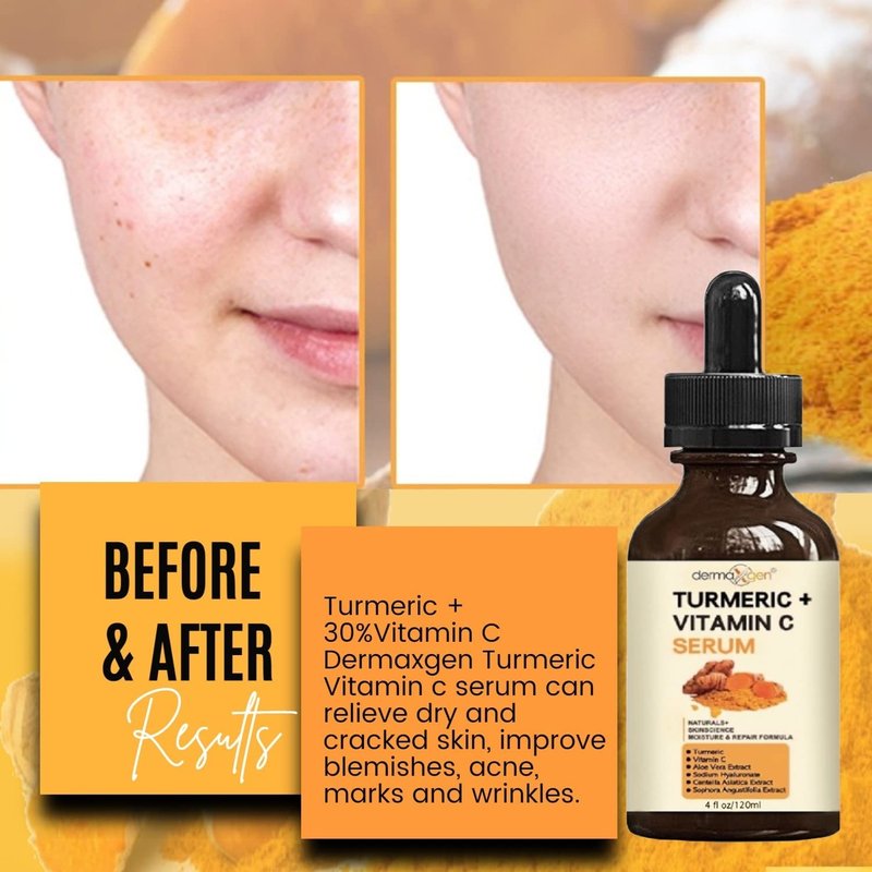 Turmeric Serum for Face + Glow-Boosting Vitamin C Serum –Organic Moisturizer for Acne, Dark Spots & Clear Skin– Boosts Hydration for Dry & Tired Skin – Anti-Aging Formula for Glowing Skin, 4 FL OZ