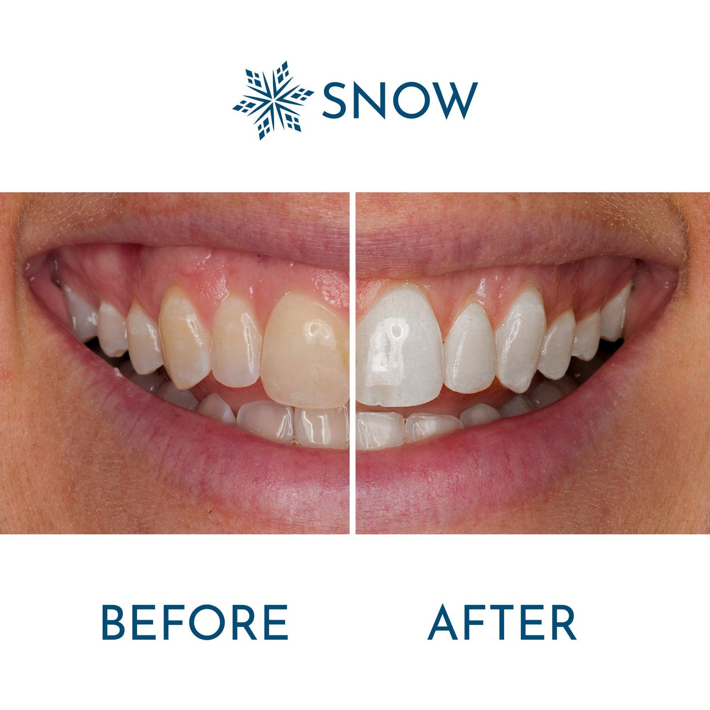 Snow Extra-Strength Teeth Whitening Serum - Oral Care Teeth Whitener Pen - Whitening Pen for Stain Removal & Whiter Teeth - Tooth Whitener with Potassium Nitrate and Hydroxyapatite - 1 Pack
