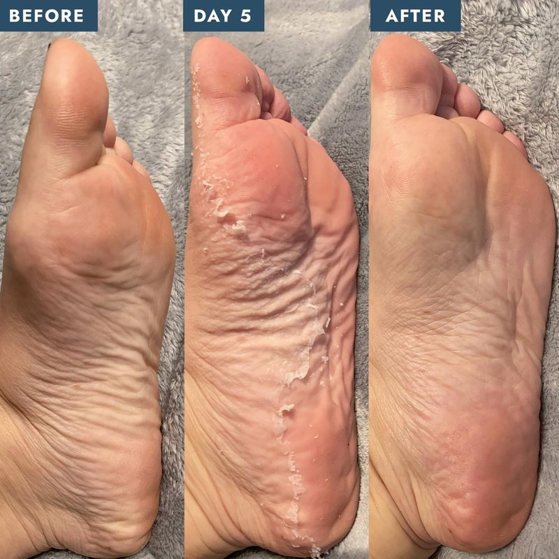 VOESH Collagen & Peeling Socks Duo, Peeling Socks, Collagen Socks, Foot Peel, Moisturizing Spa Socks, Foot Mask, Foot Exfoliator, Foot Care, Vegan