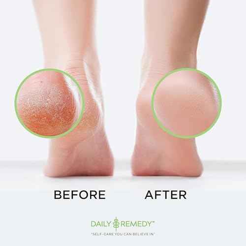 Callus Remover Gel ? Professional Foot Callus Removal for Smooth Feet & Cracked Heels ? Extra Strength Callus Gel with Pumice Stone ? 8oz, Made in USA