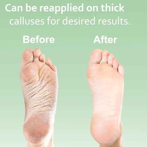 Dr. Entre's 16oz Callus Remover Gel: Extra Strength Value Size, Callus Remover for Feet, Pedicure Tools Supplies, Dead Skin Remover, Foot Care