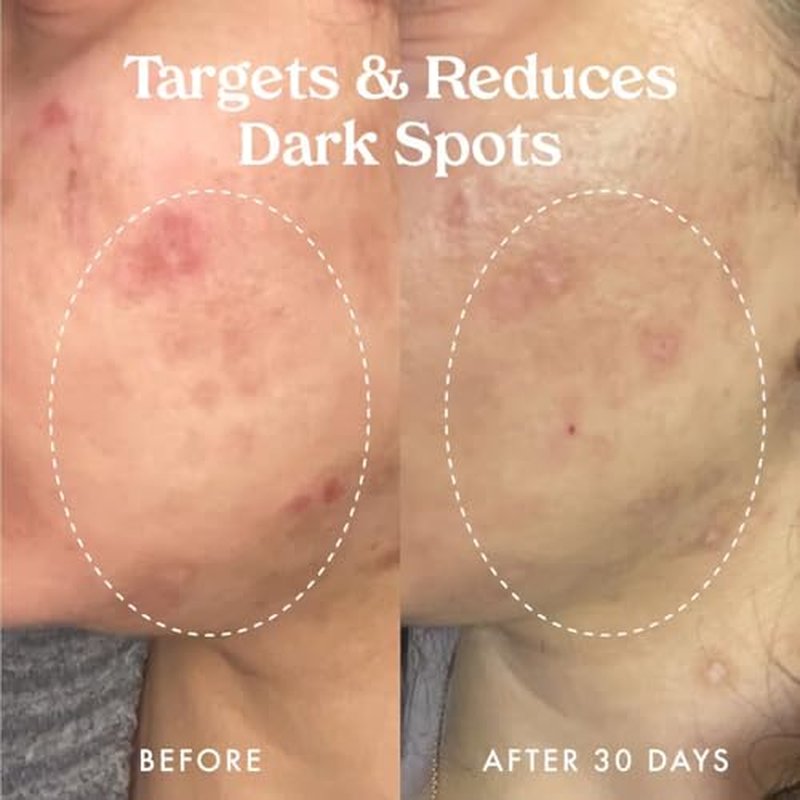 Kopari Star Bright Vitamin C Discoloration Correcting Serum with Kakadu Plum & Niacinamide, Brighter Complexion, Soothe & Diminish Dull Skin, 1.7oz