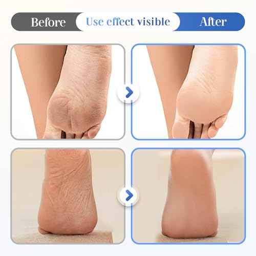 60% Urea Hydrating and Anti-Cracking Foot Cream, 2025 Upgraded Moisturising and Relieves Cracking and Dryness Foot Cream, Repairs and Hydrates Dry and Cracked Feet Hand (1)
