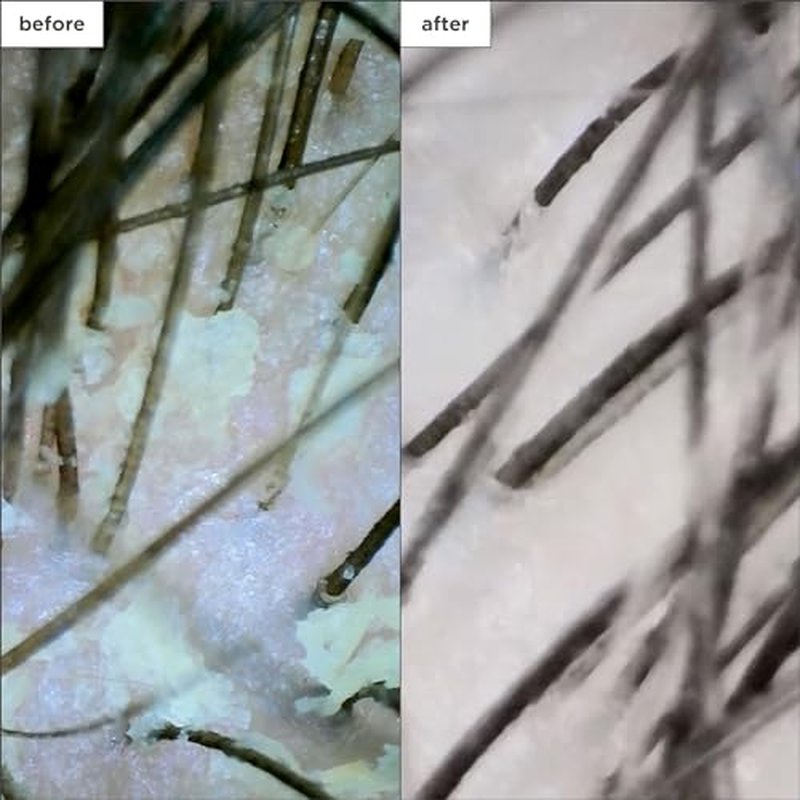 Briogeo Scalp Revival Megastrength Dandruff Shampoo, Charcoal + AHA/BHA with Salicylic Acid 3%, Anti-Dandruff Shampoo to Soothe a Dry, Flaky, Itchy Scalp,, Vegan, Cruelty-Free, 8.4 fl oz