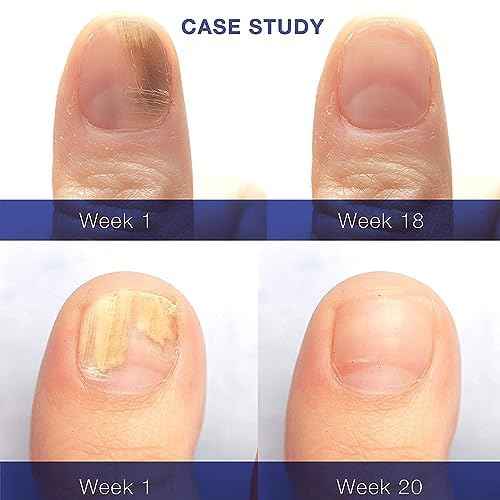 Dr. Luke Toenail Fungus Revitalizer Tough on Nails: Nail Fungus Refresher Liquid for Discolored Nails 1 oz (Packaging May Vary)