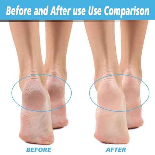 4 Pack Extra Coarse Green Replacement Roller Refills Compatible with Scholl Express Pedi Foot Smoother