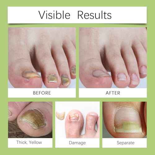 Nail Growth Serum Nail Care - Nail Repair for Damaged Toenails and Fingernails, Toenails Renewal Liquid for Thick, Damaged, Yellow, Ingrown Nails (30ml)