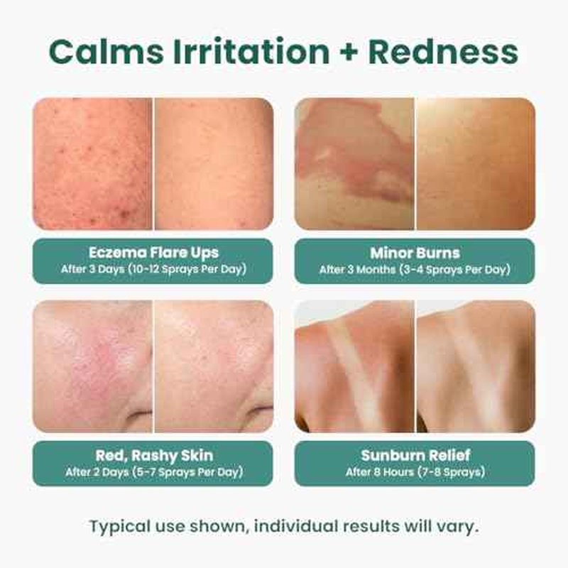 Hypochlorous Acid Spray for face (8 oz) - Face Spray for Acne, Hypochlorous Travel Size Gentle Facial & Skin Cleansing for Body, Back, Skin and Facial Cleaning & Repair - Made in USA