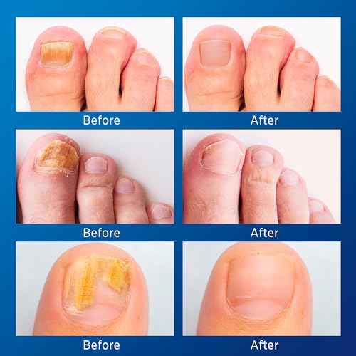 Toenail Fungus Treatment Extra Strength - Nail Fungus Treatment For Toenail Extra Strength - Nighttime Nail Patches & Nail Treatment Liquid Set (32patches+15ml)