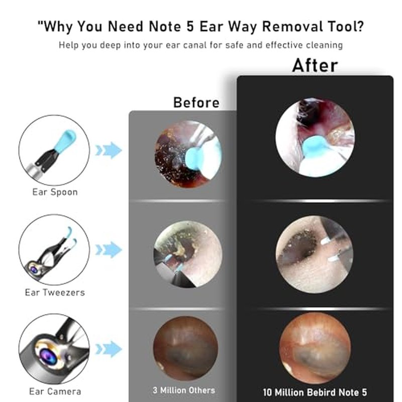 Note5 Ear Wax Tweezers with Camera, 10MP Ear Cleaner Camera Otoscope with Light,Real-time Remote Video with Ear Pick & Tweezers,12 Pcs Ear Scoops for Whole Family