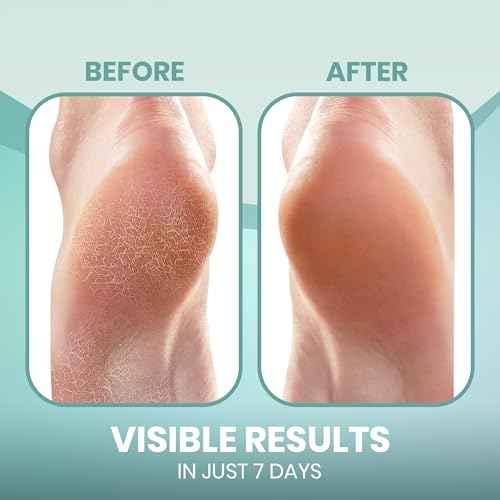 4-Pack Moisturizing Heel Socks for Cracked Heels - Gel Socks for Dry Cracked Feet Repair - Silicone Socks for Women and Men Foot Treatment & Overnight Hydration (Gray)