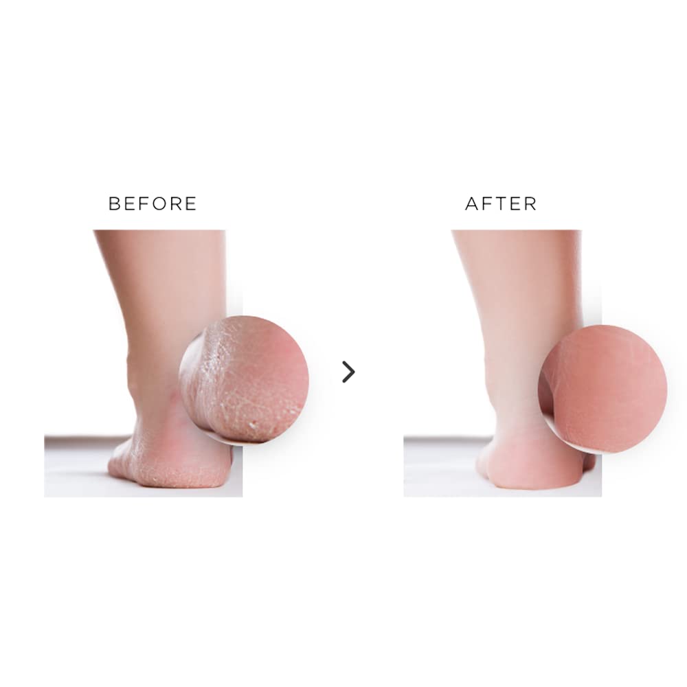 nu119 Platinum Instant Foot Peeling Spray – Professional-Grade Exfoliating Foot Peel for Dry, Cracked & Rough Skin – Callus & Dead Skin Remover – Fast-Acting Spray with Luxury Foot File