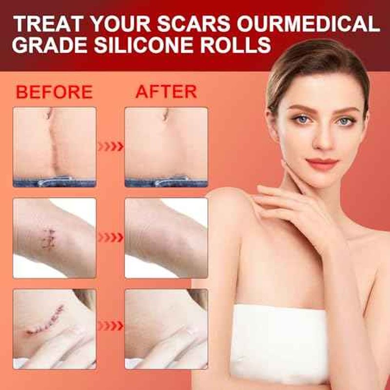 Silicone Scar Sheets (1.6¡±x 60¡± Roll-1.5M), Medical Grade Silicone Scar Tape Roll, Reusable Silicone Scar Strip, Professional Scar Removal Sheets for Surgery, C-Section, Burn, Keloid, Acne Etc