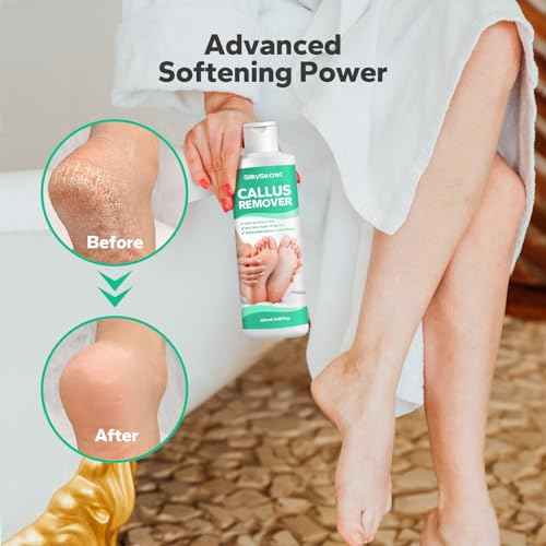 Callus Remover Gel for Feet (8.45 fl.oz), Powerful Formulation Foot Callus Remover, Extra Strength Callus Remover, Callus Remover for Feet Gel, Calloused Feet Remover Gel for Home Use