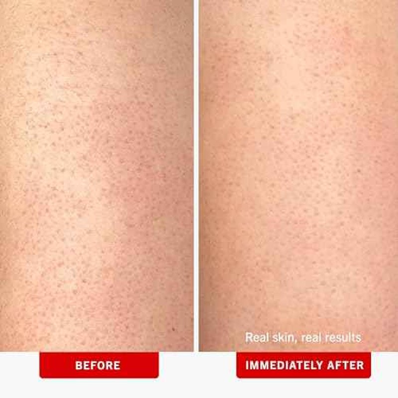 First Aid Beauty - KP Bump Eraser Body Scrub with 10% AHA, Keratosis Pilaris Exfoliator with Glycolic and Lactic acids, Helps Reduce Chicken Skin Bumps, Safe for Sensitive Skin, Strawberry Scent, 2 oz