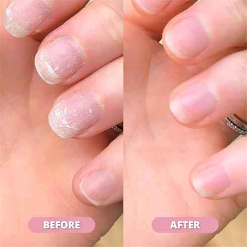 Orville Pen, Nail ???????????? Pen, ???????? ???????? NailS ???????????? Pen, Cuticle Oil for Nails - Strengthen Brittle Nails, Promote Fast-growth, Portable Pen for Healthy NailS (3pcs)