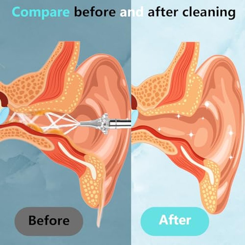 Ear Wax Removal, Portable Water Powered Ear Cleaner with Basin, Electric Ear Cleaning Kit with 3 Pressure Modes, Ear Irrigation Flushing System for Adults and Kids, (Silver)