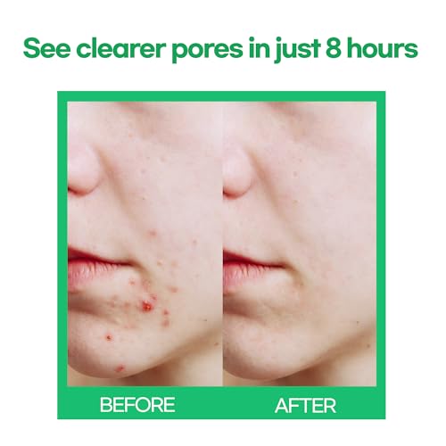 Epielle Acne Patch Shapes Edition, Acne Patches with Hydrocolloid Dressing, Fun for Parties, Sleepovers, Girls' Nights, Halloween Parties, Girls' Gift (Christmas Patch, 85ct)