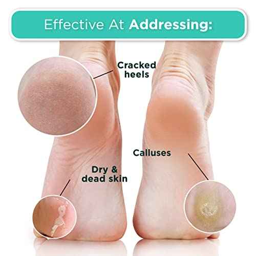 DERMORA Foot Peel Mask - 2 Pack of Regular Size Skin Exfoliating Foot Masks for Dry, Cracked Feet, Callus, Dead Skin Remover for Baby Soft Feet, Original Scent