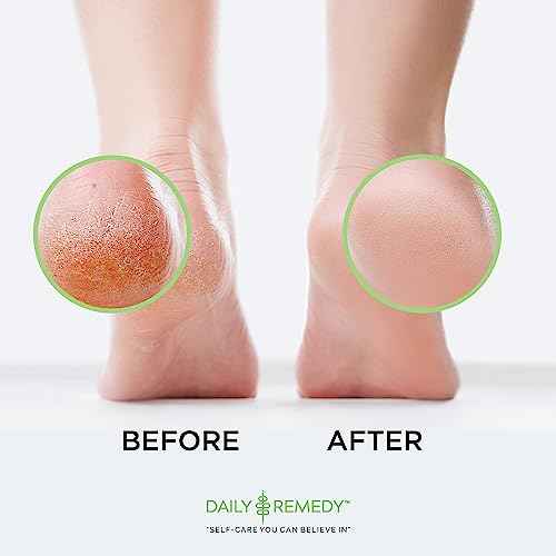 DAILY REMEDY EXTRA STRENGTH Tea Tree Oil Foot Soak w/ Epsom Salt Made in USA Toenails£¬Athlete's Foot£¬Itchy Feet£¬Stubborn Smelly Foot Odor£¬Pedicure Calluses & Soothes Sore Tired Achy Feet 16 oz£¬Black