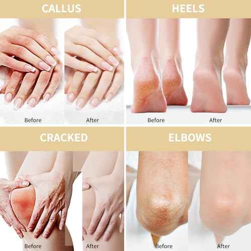 Urea Cream 50 Percent for Feet Maximum Strength 5.29 oz with Oat and 2% Salicylic Acid, Foot & Hand Cream included Hyaluronic Acid, Tea Tree and Aloe Vera for Deep Moisturizing, Callus Removing