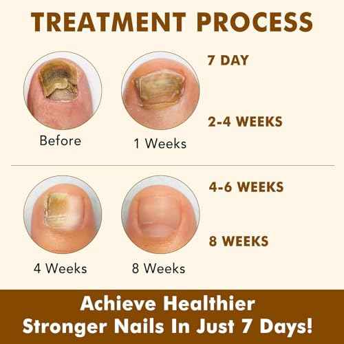 Tiuedu Nail Growth Serum, Ginger Nail Serum, Nails Repair Cuticles Oil, Ginger Nail Oil for Strengthen & Promote Nails Growth, Natural Plant Formula