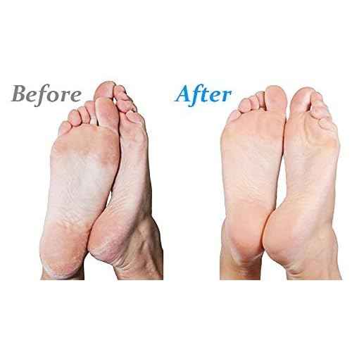 Emjoi Micro-Pedi 3D POWER Callus Remover with Xtreme Coarse Soft & Flexible Roller (Most Powerful & Corded)