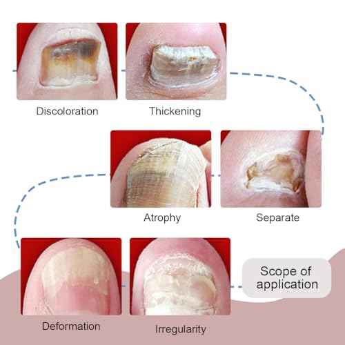 1 Pcs 7 Days Ginger Nail Treatment Nail Serum, Ginger Cuticle Care Oil for Nails, GingerNail Care Essential Oil for Strengthen & Promote Nails Growth