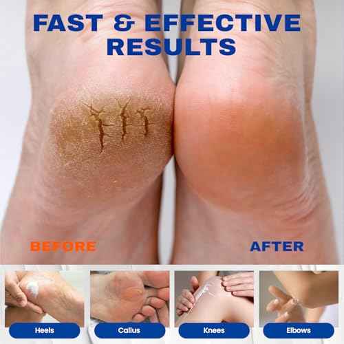 SKIN ULTIMA Urea Cream 40 Percent Plus 2% Salicylic Acid, 40% Urea Cream for Feet Maximum Strength, Foot Cream for Dry Cracked Feet, Heels, Knees, Hands & Elbows, Intensive Repair & Moisture, 5.29 oz