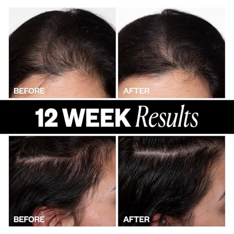 IGK Sponsored - Scalp Treatment for Hair Growth ? Hair Thickening Serum for Women ? Promotes Fuller, Thicker Hair ? Scalp Serum for Hair Density and Thinning - 2.1oz