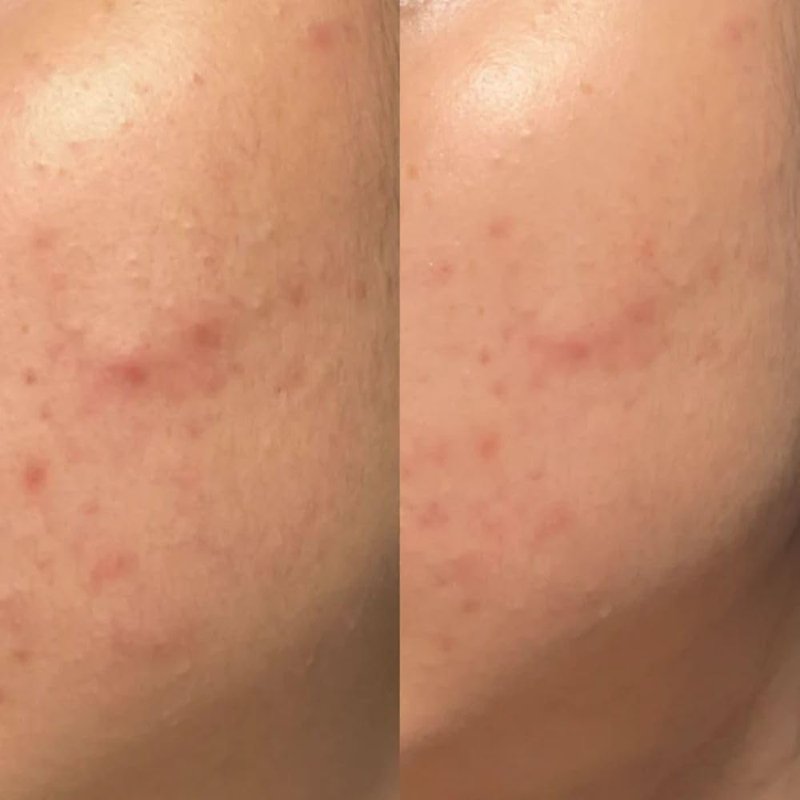 SKIN INC Deepcare Blemish SOS Pimple Patches - Overnight Acne Spot Treatment with Micro Dart Technology | Tea Tree & Salicylic Acid