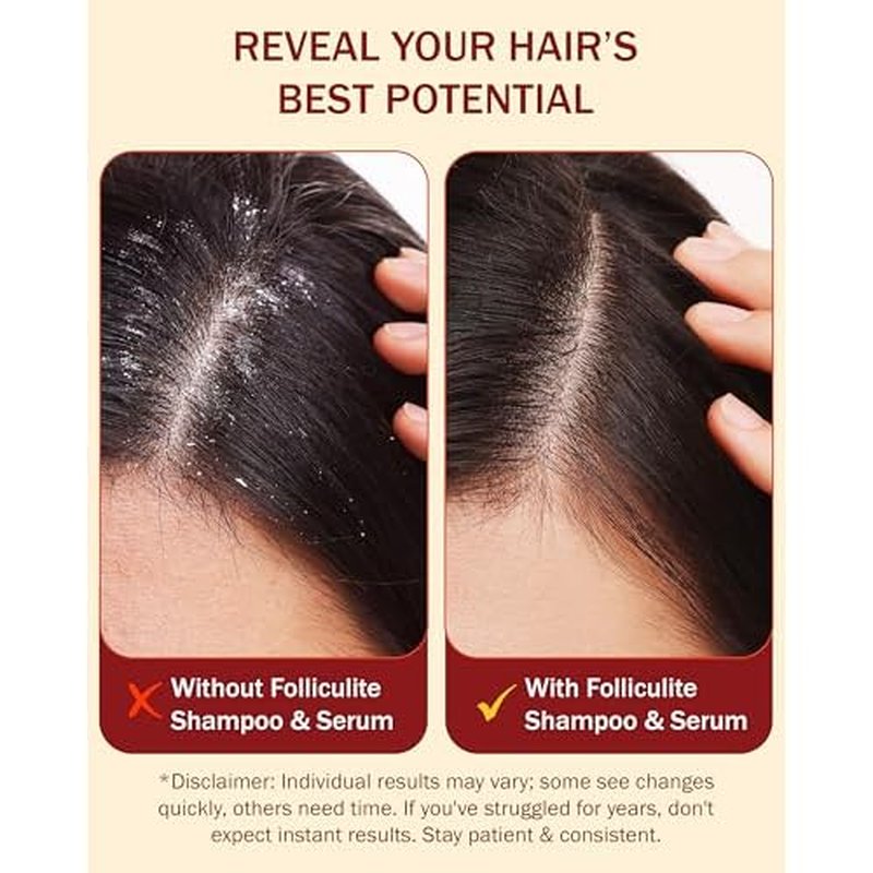 Folliculitis Treatment Shampoo & Serum with 3% BHA, Salicylic Acid, Tea Tree Oil & Chamomile Extracts - Anti Itch Shampoo for women & men with Flaky Scalp Treatment Acne, Made in USA by e70, 8 fl oz