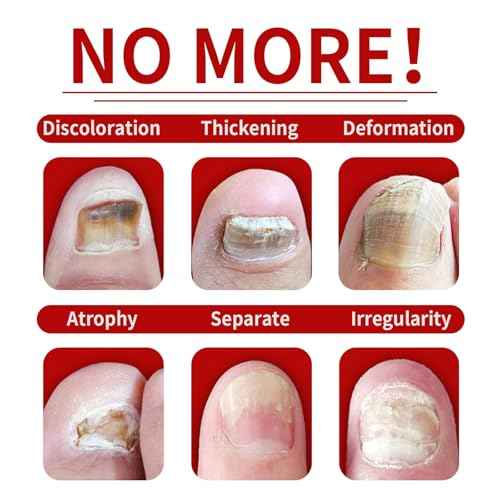 Ginger Nail Treatment, Ginger Cuticle Care Oil for Nails (2 PCS)