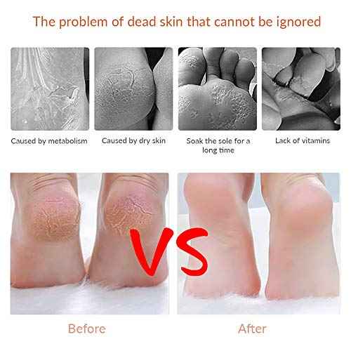 Codream Pedicure Callus Shaver Foot File Care Hard Skin Remover Callus Shaver Sets with Case, Foot File Heads & 10 Replacement Blade