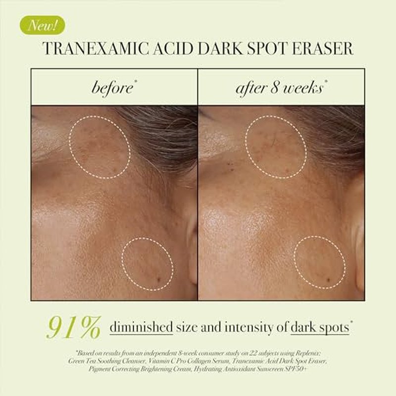 Replenix Tranexamic Acid Dark Spot Treatment, Daily Medical-Grade Topical Discoloration Serum for Uneven Skin Tone, Gluten, Paraben, Fragrance & Cruelty Free (0.5 oz)