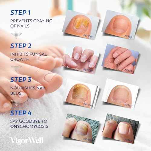 Toenail Fungus Treatment Extra Strength - Nail Fungus Treatment For Toenail Extra Strength - Nighttime Nail Patches & Nail Treatment Liquid Set (32patches+15ml)