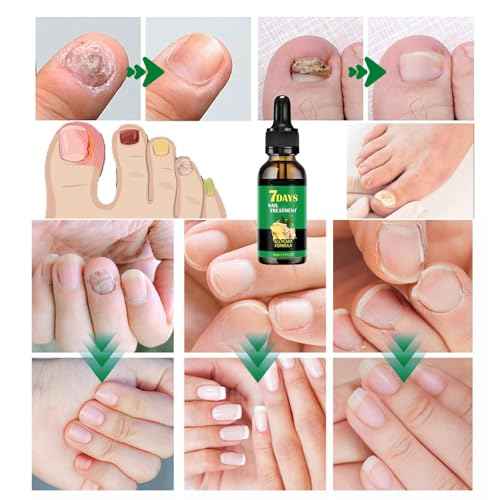 Ginger Nail Treatment Nail Support Nail Care, 7days Nail Treatment, Ginger Nail Growth Serum, Ginger Cuticle Care Oil for Nails,Cuticle Serum for Nails (2Pcs, 1 Fl.oz(pack of 1))