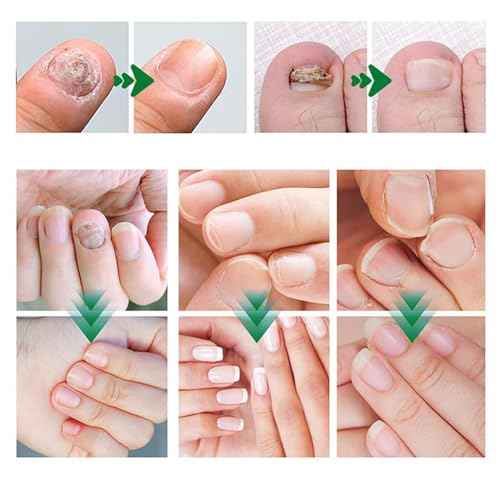 Natural Nail Treatment Gel, Nail Growth Serum for Repair & Strengthener (2)