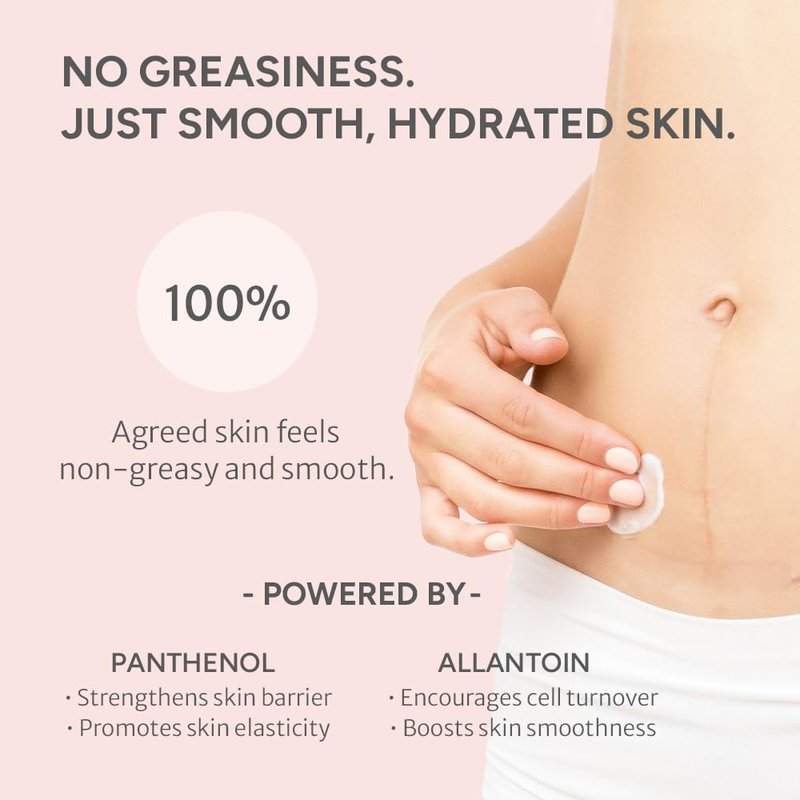 Noelo Hills Advanced Stretch Mark Cream for Pregnancy, Weight Gain, Growth Spurts - Pregnancy-Safe - Korean Skincare - Clinically Proven - Ultra Clean Ingredients - Fragrance Free - Vegan - 6.76 fl oz