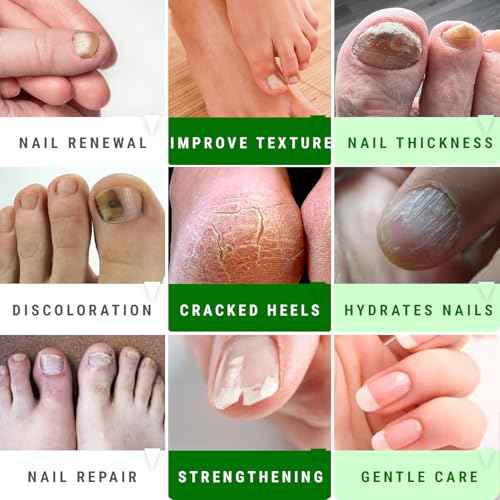 Urea Nail Gel - Softens Cracked Heel Calluses & Thick Toenails - Repairs Damaged, Yellow, Discolored Nails ? Highly Effective & Quick-Dry Fingernails & Toenail Treatment (Urea 40%)